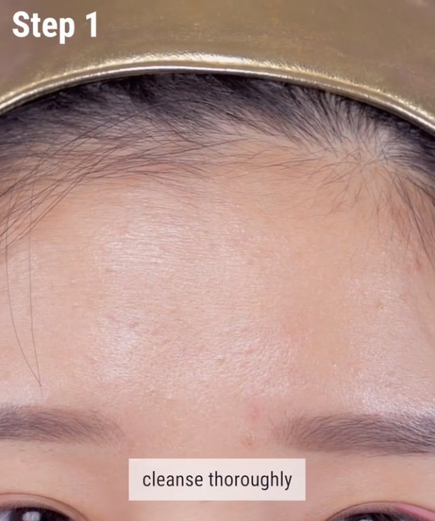 Nếu bạn đang khổ sở vì mụn đầu trắng thì đây chính là bí kíp nặn mụn chuẩn nhất dành cho bạn