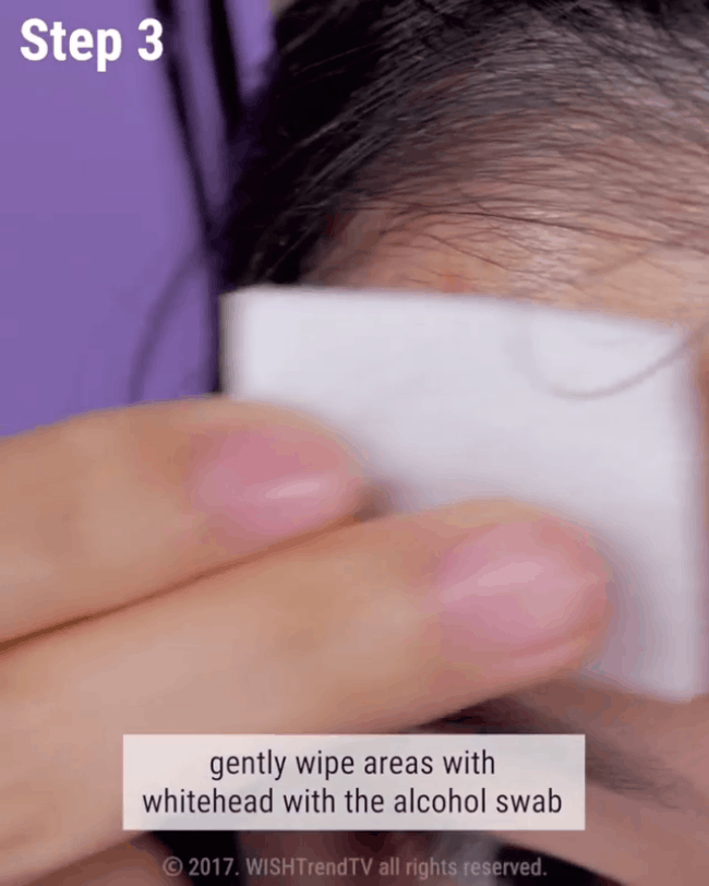 Nếu bạn đang khổ sở vì mụn đầu trắng thì đây chính là bí kíp nặn mụn chuẩn nhất dành cho bạn