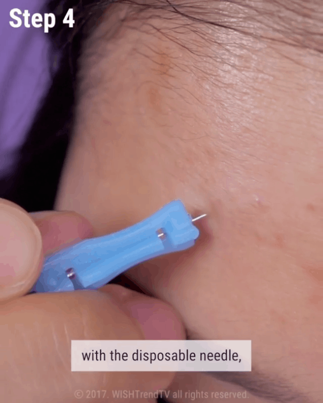 Nếu bạn đang khổ sở vì mụn đầu trắng thì đây chính là bí kíp nặn mụn chuẩn nhất dành cho bạn