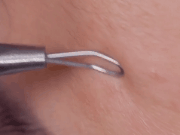 Nếu bạn đang khổ sở vì mụn đầu trắng thì đây chính là bí kíp nặn mụn chuẩn nhất dành cho bạn