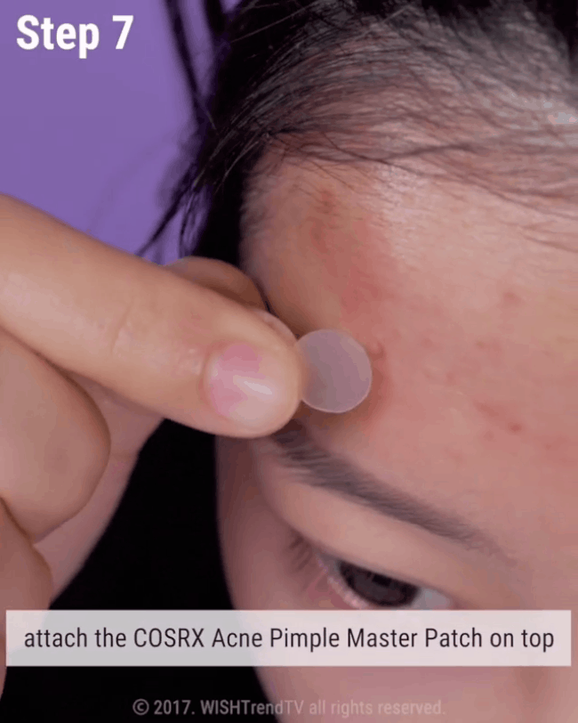 Nếu bạn đang khổ sở vì mụn đầu trắng thì đây chính là bí kíp nặn mụn chuẩn nhất dành cho bạn