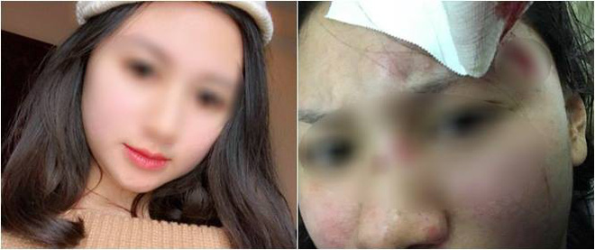 Hà Nội: Người vợ xinh đẹp tố bị chồng đánh rách đầu, mang bầu cũng hành hung không tha