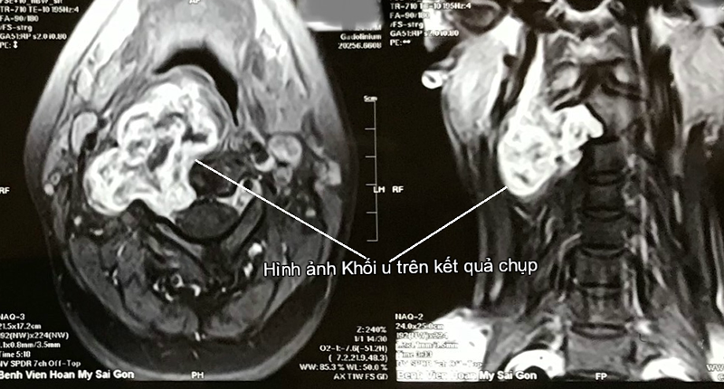 Cô gái suýt câm vì bác sĩ nhầm khối u là hạch cổ