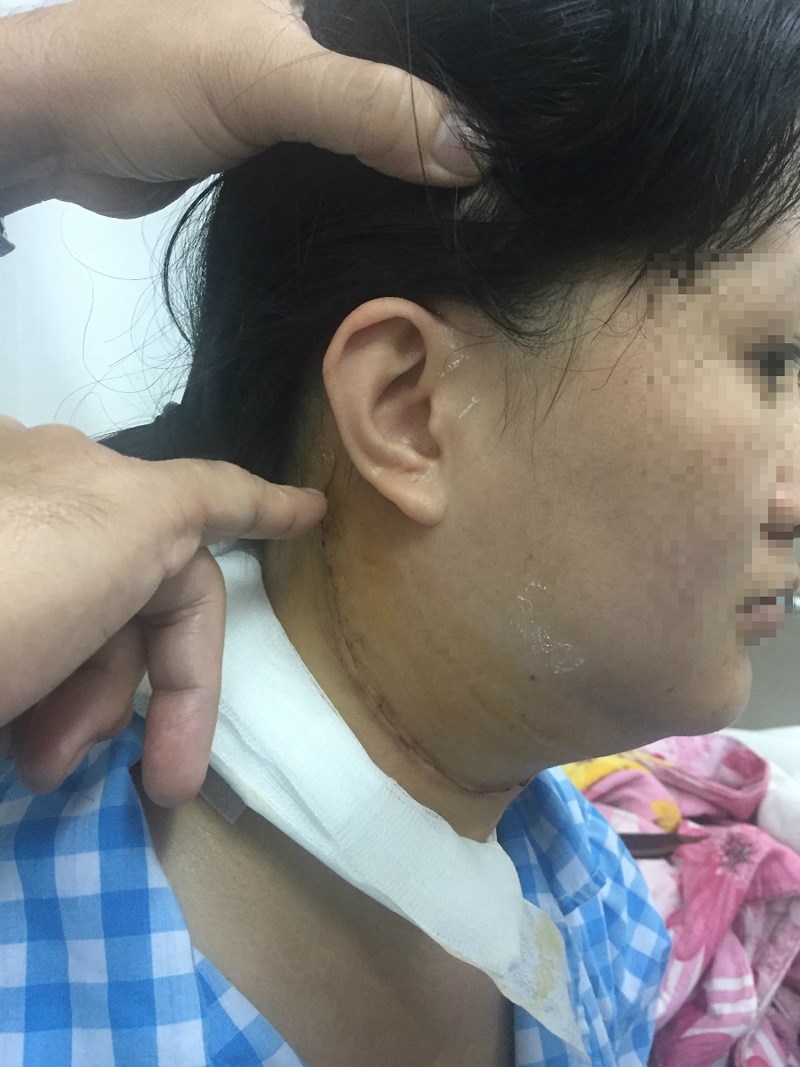Cô gái suýt câm vì bác sĩ nhầm khối u là hạch cổ