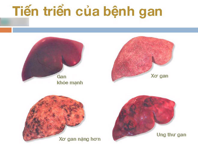 70 - 80% ca mắc ung thư gan xuất phát từ nguyên nhân này, hãy phòng tránh ngay từ hôm nay 70 - 80% ca mắc ung thư gan xuất phát từ nguyên nhân này, hãy phòng tránh ngay từ hôm nay