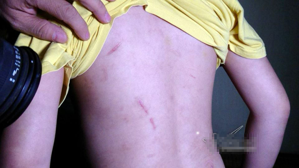 Bé trai bị bố và mẹ kế đánh rạn sọ não xin tha cho bố Bé trai bị bố và mẹ kế đánh rạn sọ não xin tha cho bố