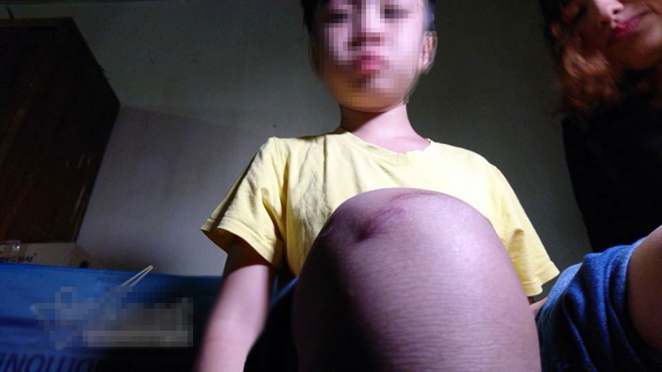 Bé trai bị bố và mẹ kế đánh rạn sọ não xin tha cho bố