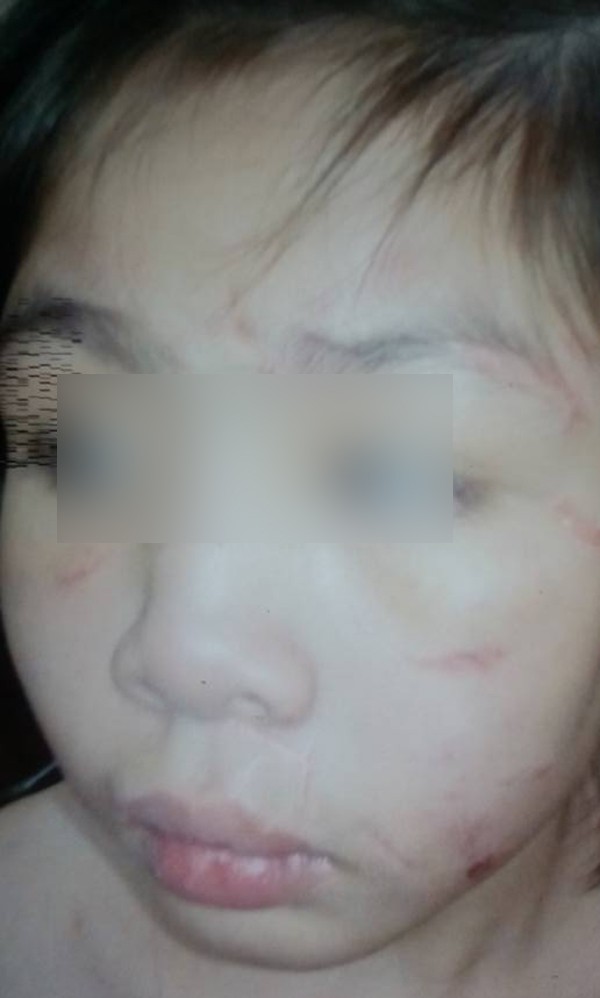 Vụ bé trai 10 tuổi bị bạo hành dã man: Mẹ kế thừa nhận bạo hành con chồng vì cháu ăn vụng thịt bò