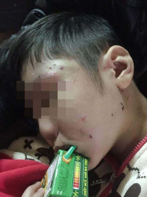 Bác sĩ tâm lý mổ xẻ vụ bố, mẹ kế bạo hành bé trai 10 tuổi