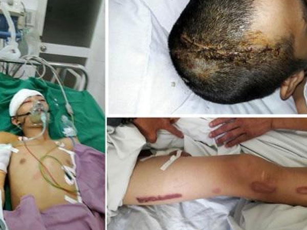 Sốc với lời cháu bé trộm vặt bị chém liệt nửa người