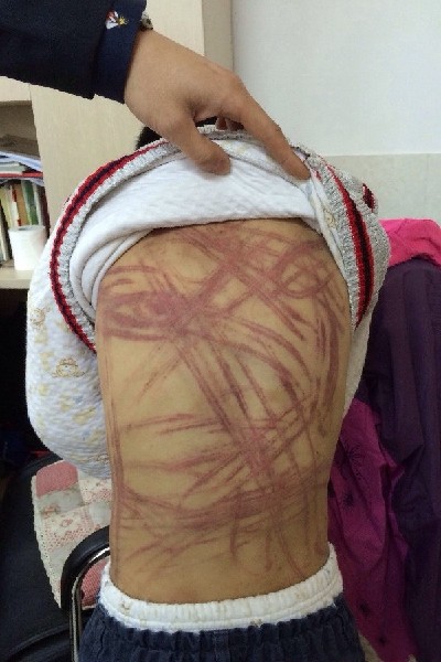 Bé trai 5 tuổi bị mẹ nuôi ngược đãi đến chết rồi bỏ vào vali mang chôn ở bãi đất hoang