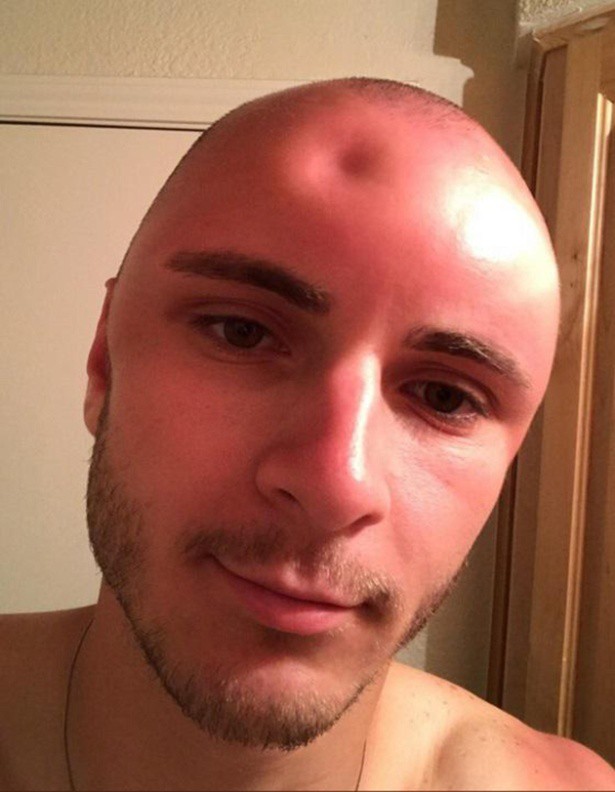 Chàng trai bị lõm đầu vì phơi nắng quá lâu