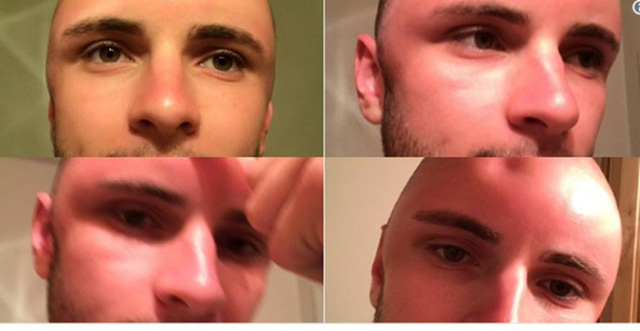 Chàng trai bị lõm đầu vì phơi nắng quá lâu