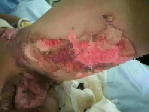 Kinh hoàng: Hai học sinh tiểu học bị bạn cùng lớp dội nước sôi vào người gây nhiễm trùng nghiêm trọng