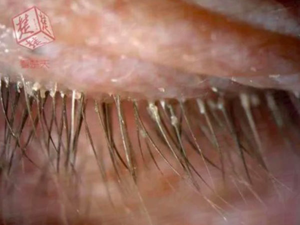 Hơn 4 năm liền không giặt gối, người phụ nữ đi khám và phát hiện hơn 100 con rận trong mi mắt