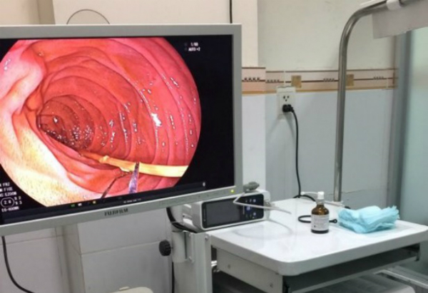 6 cây nhang cháy dở nằm trong ruột người đàn ông