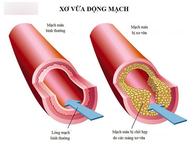 5 triệu chứng cảnh báo mạch máu bị tắc, cần xử lý ngay để tránh tử vong bất ngờ 5 triệu chứng cảnh báo mạch máu bị tắc, cần xử lý ngay để tránh tử vong bất ngờ