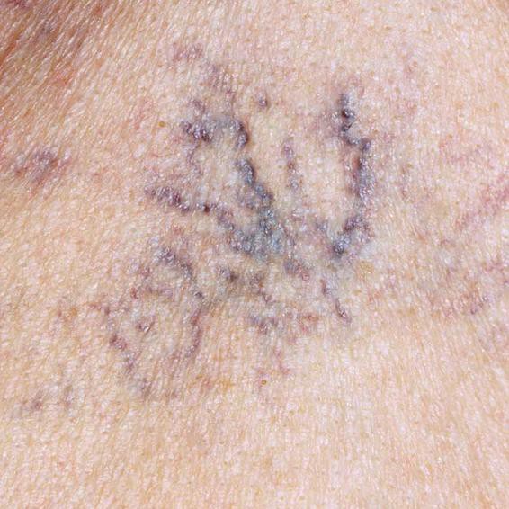 6 dấu hiệu cảnh báo gan của bạn có thể đang... bị hỏng