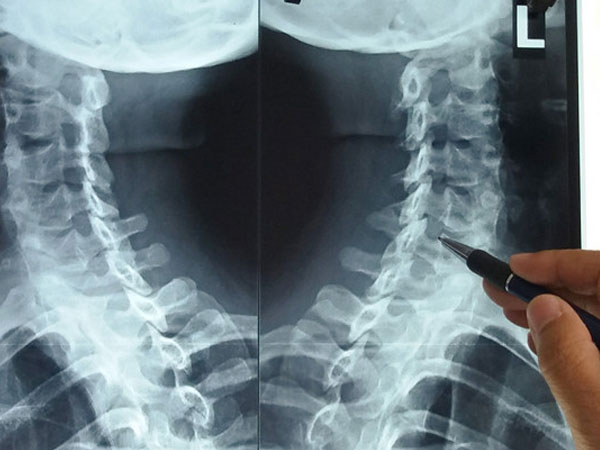 Dân văn phòng đừng chủ quan khi thoái hóa đốt sống cổ