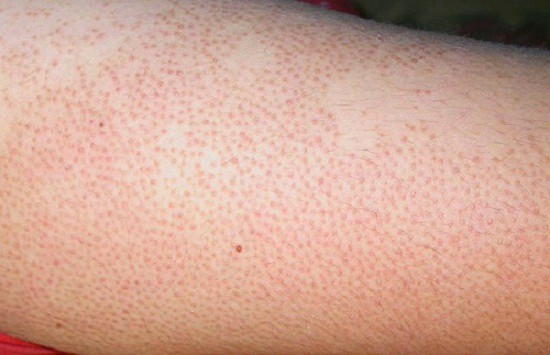 Xuất hiện những chấm trắng trên da như này, đừng chủ quan vì có thể là dấu hiệu của bệnh nguy hiểm