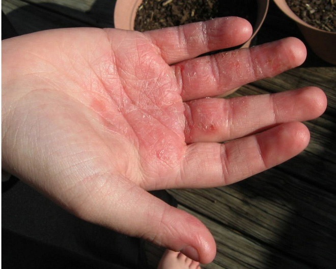 Xuất hiện những chấm trắng trên da như này, đừng chủ quan vì có thể là dấu hiệu của bệnh nguy hiểm