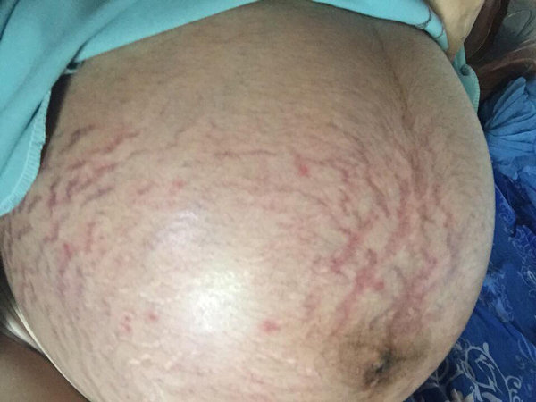 Xót xa những chiếc bụng rạn nứt như dưa lưới của các mẹ mang thai đôi