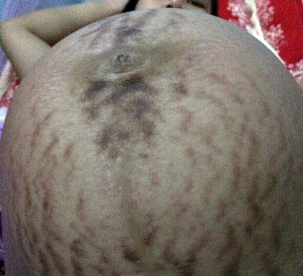 Xót xa những chiếc bụng rạn nứt như dưa lưới của các mẹ mang thai đôi