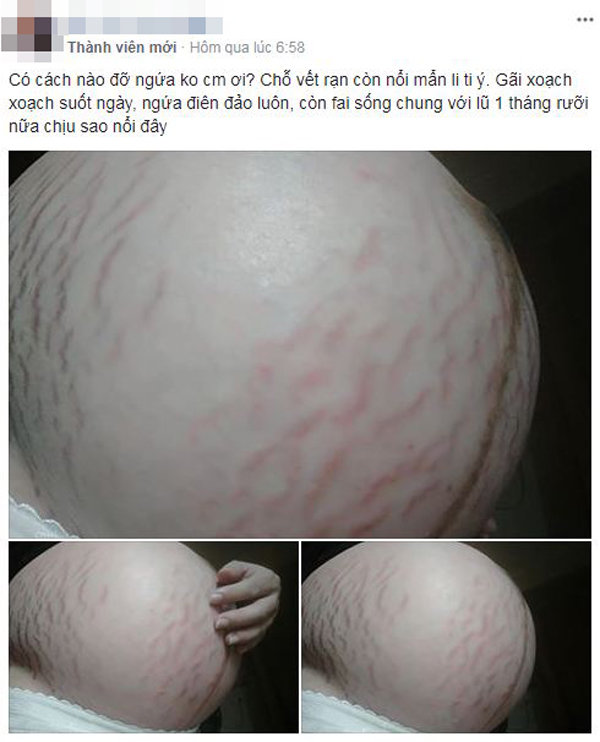 Xót xa những chiếc bụng rạn nứt như dưa lưới của các mẹ mang thai đôi