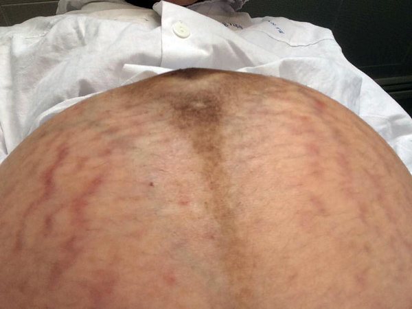 Xót xa những chiếc bụng rạn nứt như dưa lưới của các mẹ mang thai đôi