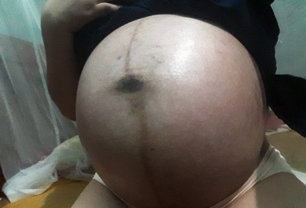 Xót xa những chiếc bụng rạn nứt như dưa lưới của các mẹ mang thai đôi