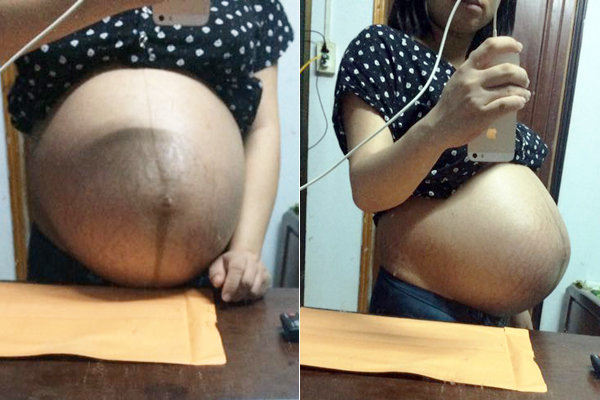 Xót xa những chiếc bụng rạn nứt như dưa lưới của các mẹ mang thai đôi
