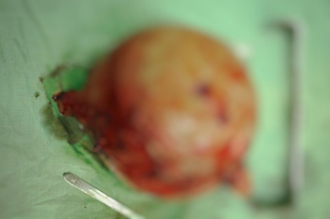 Phẫu thuật thành công khối u xơ tử cung nặng gần 6 kg