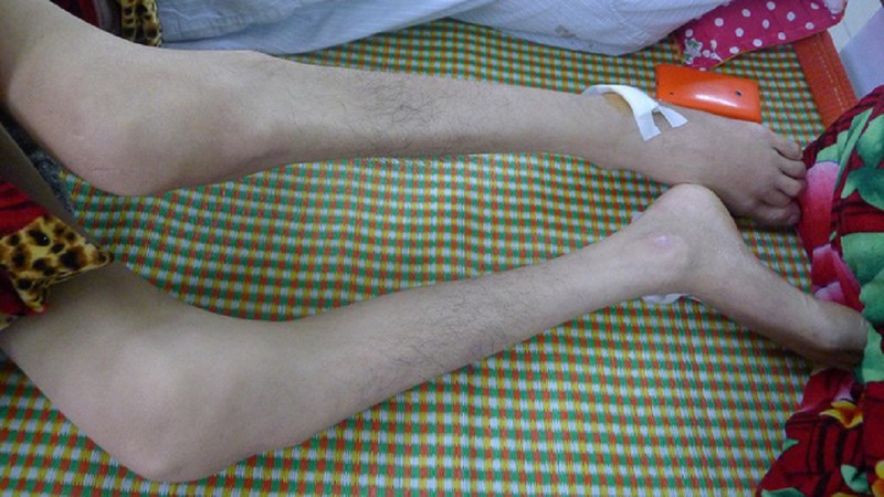 Mắc bệnh lạ, thanh niên bị vi khuẩn ăn tim nguy kịch