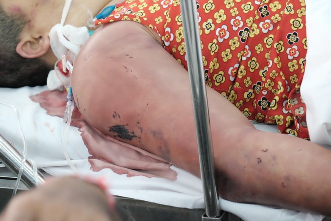 Nghi ma nhập hai chị em bị thầy pháp dùng doi dâu đánh thâm tím toàn thân, khiến nguy kịch Nghi ma nhập hai chị em bị thầy pháp dùng doi dâu đánh thâm tím toàn thân, khiến nguy kịch