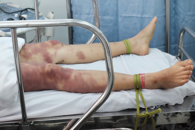 Nghi ma nhập hai chị em bị thầy pháp dùng doi dâu đánh thâm tím toàn thân, khiến nguy kịch