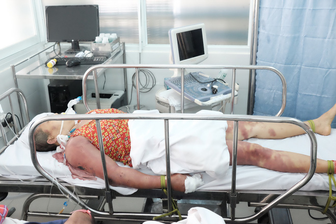 Nghi ma nhập hai chị em bị thầy pháp dùng doi dâu đánh thâm tím toàn thân, khiến nguy kịch Nghi ma nhập hai chị em bị thầy pháp dùng doi dâu đánh thâm tím toàn thân, khiến nguy kịch