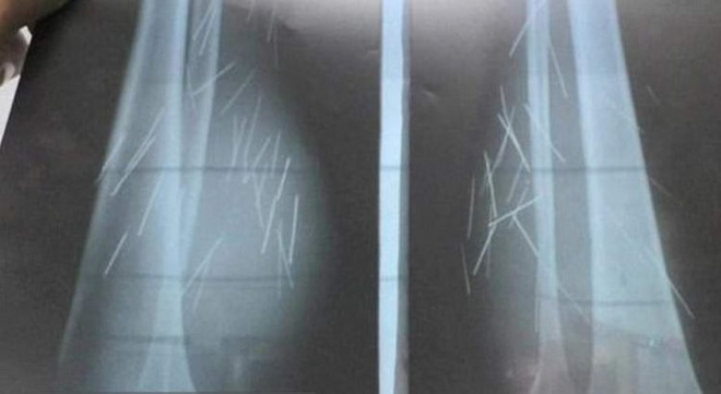 Chụp X-quang, bác sĩ phát hiện nhiều vật lạ trong chân cô gái và không thể tin nổi khi lấy ra