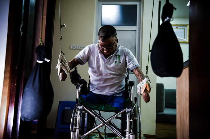 Cuộc sống sau 24 lần phẫu thuật của người lính vụ máy bay rơi