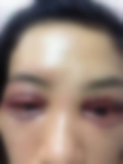 Khách nữ tố Spa cắt mí mắt hỏng còn bắt livestream xin lỗi: ‘2 bên đã tự hòa giải, mắt tôi không sao rồi’