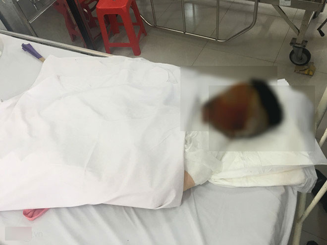 Thiếu nữ miền Tây bị tạt axit hủy hoại toàn bộ khuôn mặt