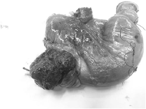 Khối u hiếm gặp khiến người đàn ông bị tắc ruột suốt ba ngày