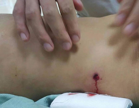 Truy bắt nhóm nổ súng vào quán karaoke lạc vào người đi đường