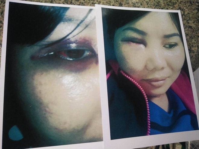 Bị người yêu của chồng kéo đến nhà đánh bầm mặt, chảy máu đầu, người phụ nữ hơn 1 năm đi kiện