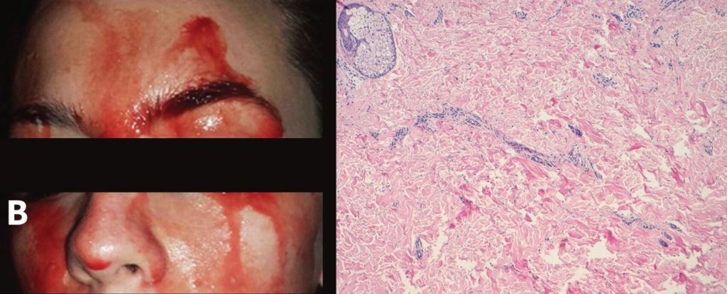 Chứng bệnh hiếm có kỳ lạ khiến cô gái này đổ MÁU thay mồ hôi