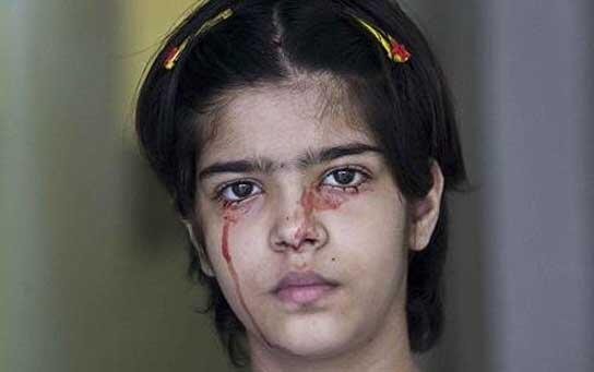 Chứng bệnh hiếm có kỳ lạ khiến cô gái này đổ MÁU thay mồ hôi