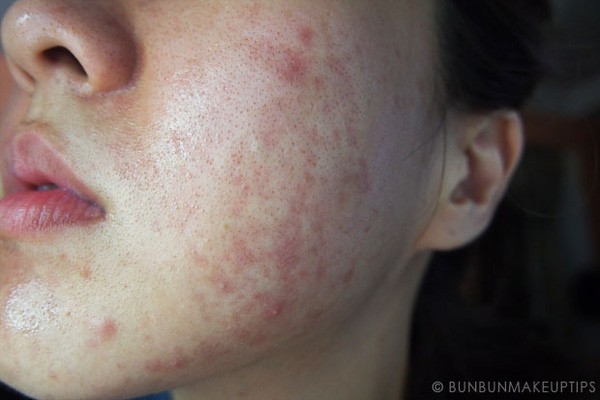 Liệu bạn có biết, da bị mụn hay kích ứng một phần cũng là do mỹ phẩm bảo quản không đúng cách Liệu bạn có biết, da bị mụn hay kích ứng một phần cũng là do mỹ phẩm bảo quản không đúng cách