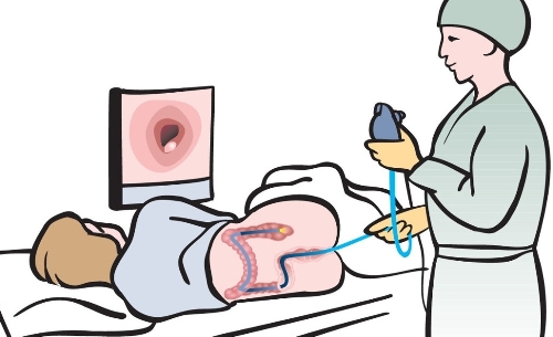 Hai xét nghiệm giúp loại bỏ sớm tế bào ung thư