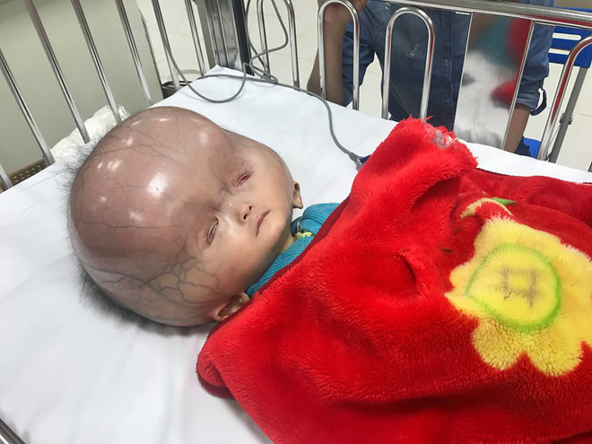 Mẹ của bé trai sinh ra có đầu to như quả bóng: Chồng và gia đình chồng đều bỏ mẹ con tôi