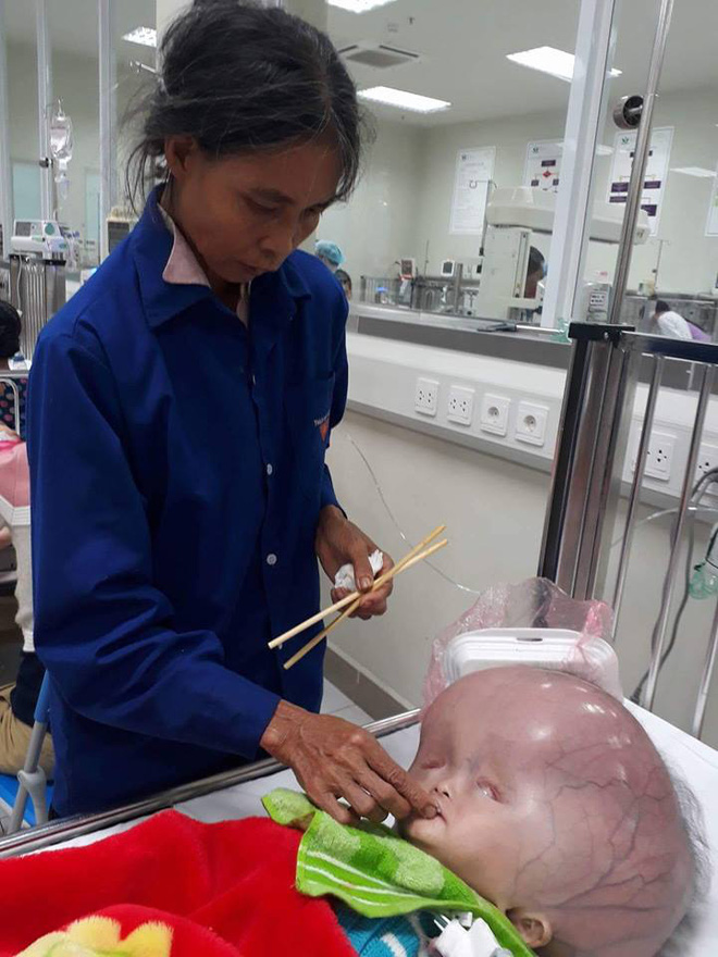 Mẹ của bé trai sinh ra có đầu to như quả bóng: Chồng và gia đình chồng đều bỏ mẹ con tôi