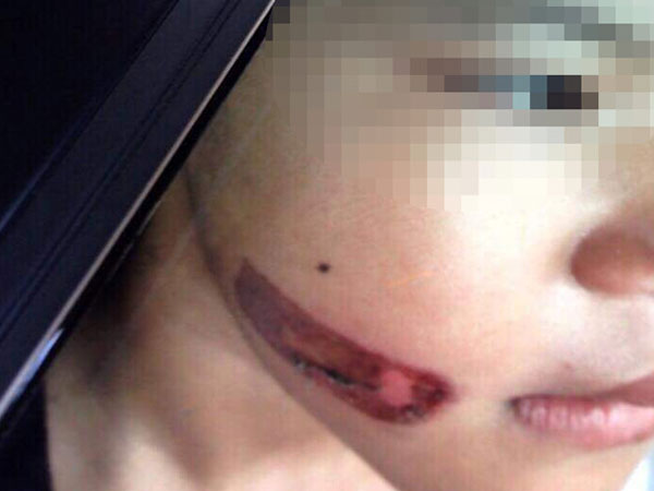 Công an điều tra nghi án bé gái bị cha dí sắt nóng vào mặt